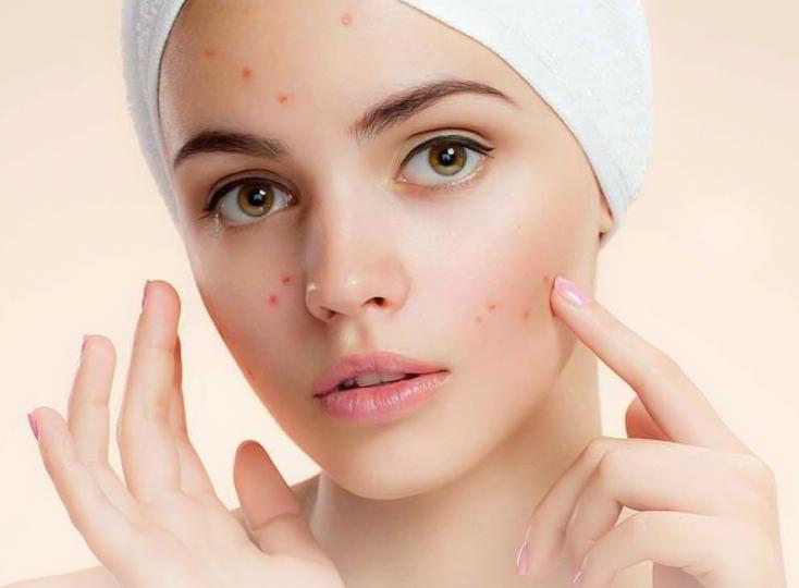 أماكن الحبوب أسباب حبوب الوجه