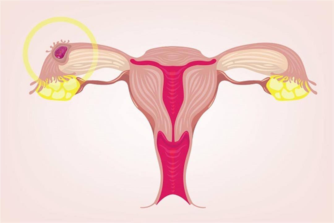 متى تظهر أعراض الحمل خارج الرحم